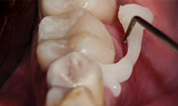 clinical image - cleanup after crown seating